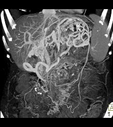 Adenocarcinoma of the Pancreas With Venous Invasion - CTisus CT Scan