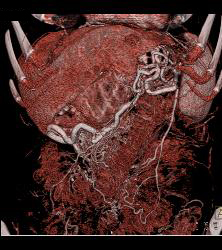 Adenocarcinoma of the Pancreas With Venous Invasion - CTisus CT Scan