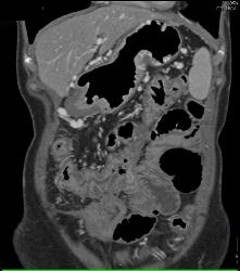 Pancreatic Cancer With Cavernous Transformation of the Portal Vein (CTPV) - CTisus CT Scan