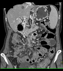 Pancreatic Cancer With Cavernous Transformation of the Portal Vein (CTPV) - CTisus CT Scan