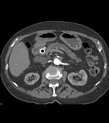 Stenosis Superior Mesenteric Artery (SMA) in Patient With Pancreatic Cancer - CTisus CT Scan