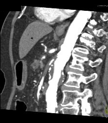 Stenosis Superior Mesenteric Artery (SMA) in Patient With Pancreatic Cancer - CTisus CT Scan