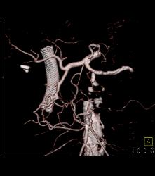 Stenosis Superior Mesenteric Artery (SMA) in Patient With Pancreatic Cancer - CTisus CT Scan