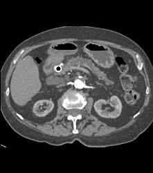 Stenosis Superior Mesenteric Artery (SMA) in Patient With Pancreatic Cancer - CTisus CT Scan