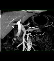 Stenosis Superior Mesenteric Artery (SMA) in Patient With Pancreatic Cancer - CTisus CT Scan