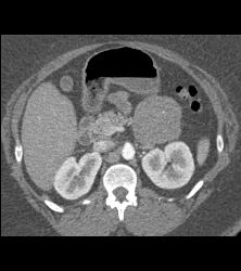 Unusual SPEN Tumor - CTisus CT Scan