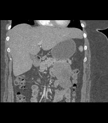 Unusual SPEN Tumor - CTisus CT Scan