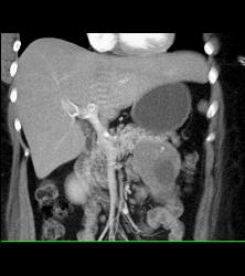 Unusual SPEN Tumor - CTisus CT Scan