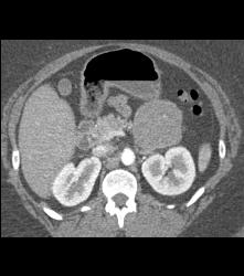 Unusual SPEN Tumor - CTisus CT Scan