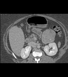 Unusual SPEN Tumor - CTisus CT Scan