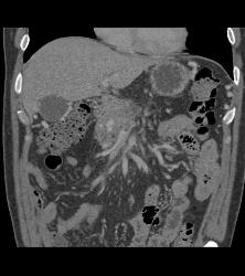 Invasive Pancreatic Cancer Encases PV/SMV - CTisus CT Scan