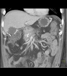 Invasive Pancreatic Cancer Encases PV/SMV - CTisus CT Scan