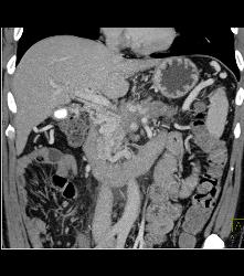 Invasive Pancreatic Cancer Encases PV/SMV - CTisus CT Scan