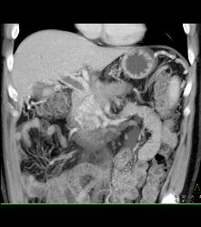 Invasive Pancreatic Cancer Encases PV/SMV - CTisus CT Scan