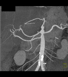 Accessory Right Hepatic Artery Off SMA - CTisus CT Scan