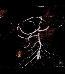 Accessory Right Hepatic Artery Off SMA - CTisus CT Scan