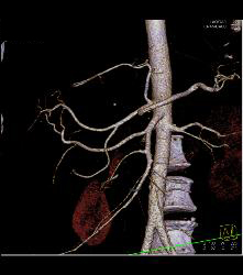 Accessory Right Hepatic Artery Off SMA - CTisus CT Scan