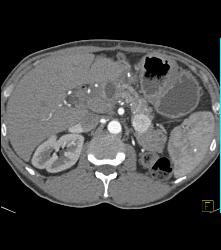 Metastatic Renal Cell Carcinoma to Pancreas - CTisus CT Scan