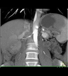 Metastatic Renal Cell Carcinoma to Pancreas - CTisus CT Scan