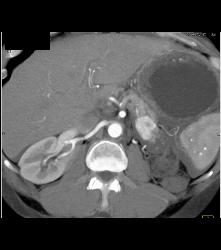 Metastatic Renal Cell Carcinoma to Pancreas - CTisus CT Scan