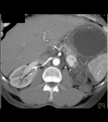 Metastatic Renal Cell Carcinoma to Pancreas - CTisus CT Scan