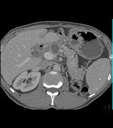 Metastatic Renal Cell Carcinoma to Pancreas - CTisus CT Scan