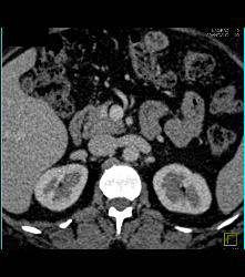 5mm Islet Cell in the Head of the Pancreas- Subtle - CTisus CT Scan