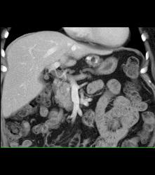 5mm Islet Cell in the Head of the Pancreas- Subtle - CTisus CT Scan