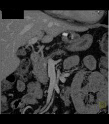 5mm Islet Cell in the Head of the Pancreas- Subtle - CTisus CT Scan