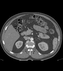 Intraductal Papillary Mucinous Neoplasm (IPMN) - CTisus CT Scan