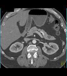 Intraductal Papillary Mucinous Neoplasm (IPMN) - CTisus CT Scan