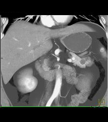 Intraductal Papillary Mucinous Neoplasm (IPMN) - CTisus CT Scan