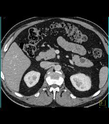 Intraductal Papillary Mucinous Neoplasm (IPMN) - CTisus CT Scan