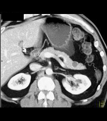 Intraductal Papillary Mucinous Neoplasm (IPMN) - CTisus CT Scan