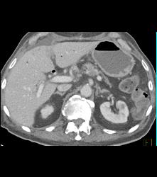 Intraductal Papillary Mucinous Neoplasm (IPMN) - CTisus CT Scan