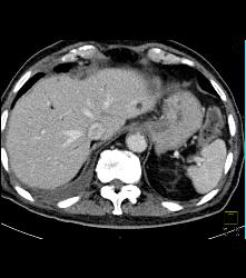 S/p Whipple Procedure - CTisus CT Scan