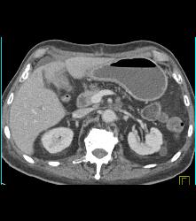 Recurrent Pancreatic Cancer S/p Whipple Procedure - CTisus CT Scan