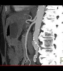 Recurrent Pancreatic Cancer S/p Whipple Procedure - CTisus CT Scan