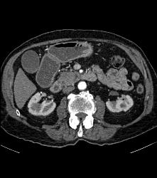 Recurrent Pancreatic Cancer S/p Whipple Procedure - CTisus CT Scan