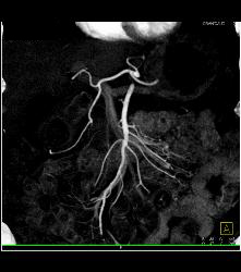 Recurrent Pancreatic Cancer S/p Whipple Procedure - CTisus CT Scan