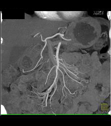 Recurrent Pancreatic Cancer S/p Whipple Procedure - CTisus CT Scan