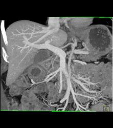 Recurrent Pancreatic Cancer S/p Whipple Procedure - CTisus CT Scan