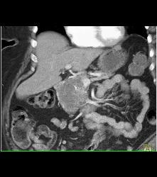 Cystadenoma - CTisus CT Scan