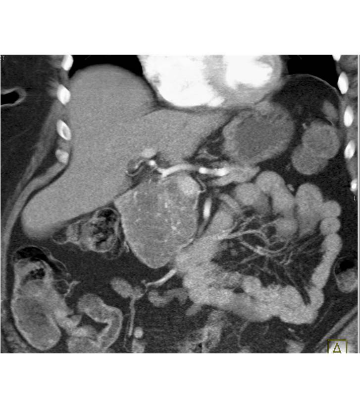 Pancreatic Cystadenoma - CTisus CT Scan