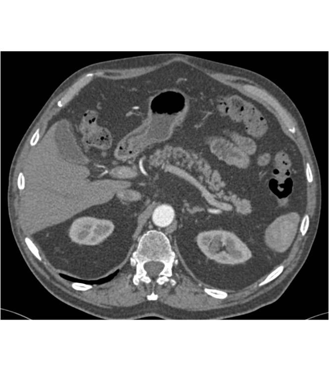 Islet Cell Tumor of the Tail of the Pancreas - CTisus CT Scan