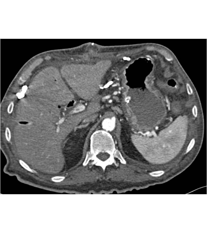 Stents in Place For Pancreatic Mass - CTisus CT Scan