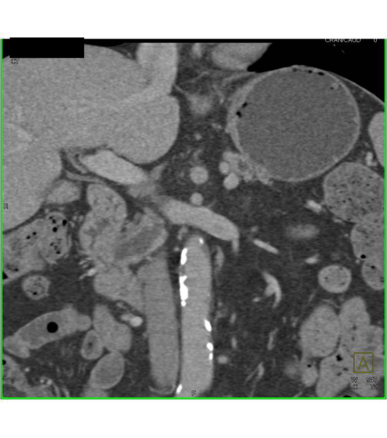 Pancreatic Cancer Arises in a Central Intraductal Papillary Mucinous Neoplasm (IPMN) - CTisus CT Scan