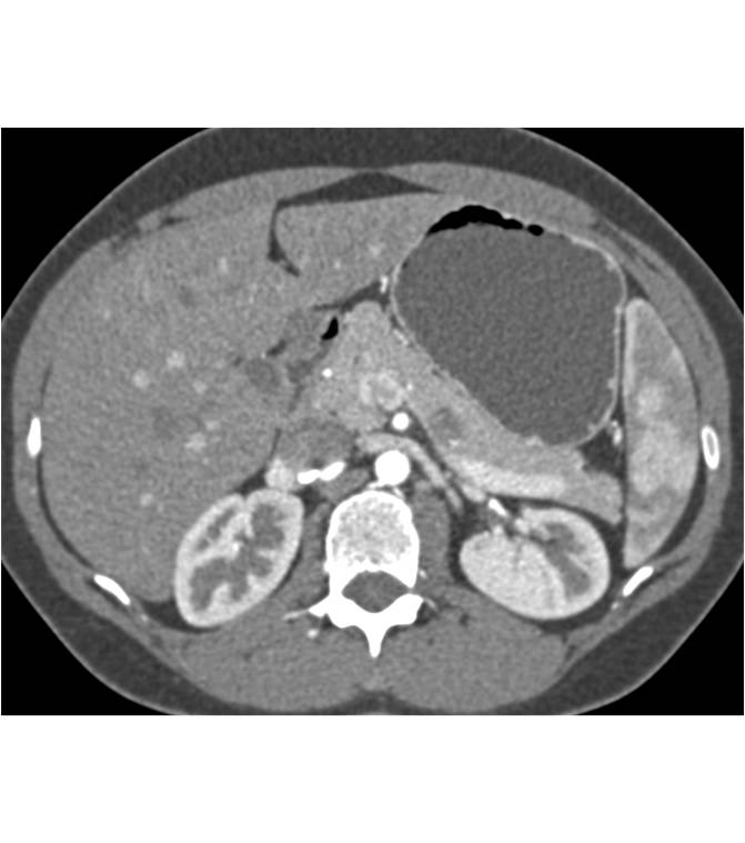 Subtle Intraductal Papillary Mucinous Neoplasm (IPMN) in the Body of the Pancreas - CTisus CT Scan