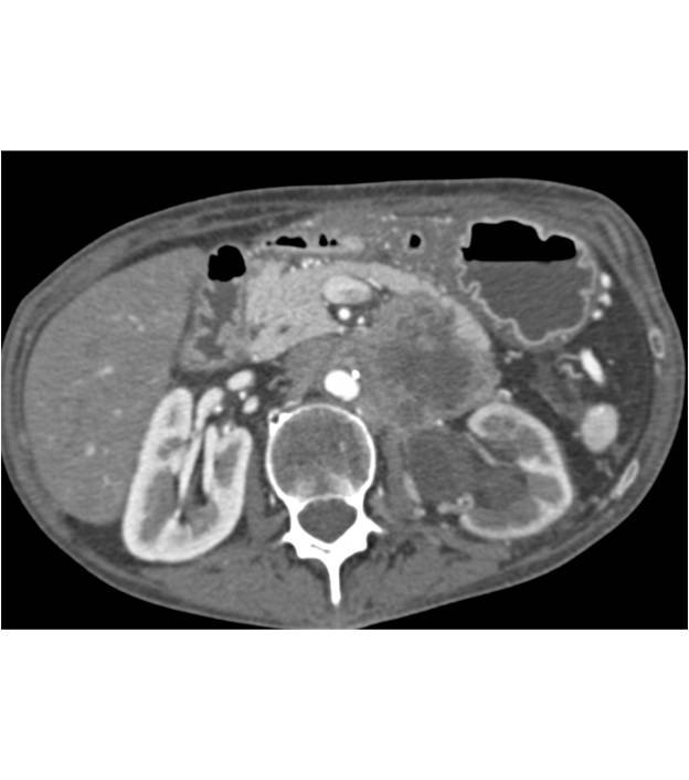 Pancreatic Adenocarcinoma - CTisus CT Scan