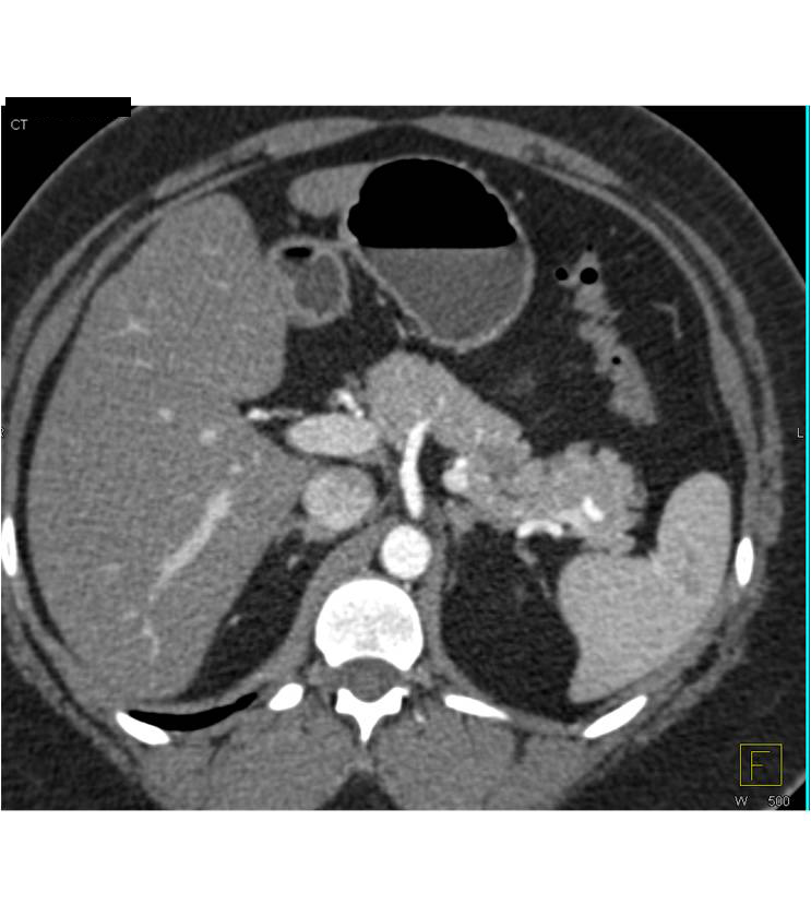 Intraductal Papillary Mucinous Neoplasm (IPMN) with Dysplastic Changes - CTisus CT Scan